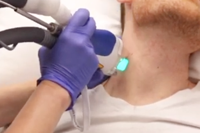 A man having a laser hair removal procedure with Splendor X