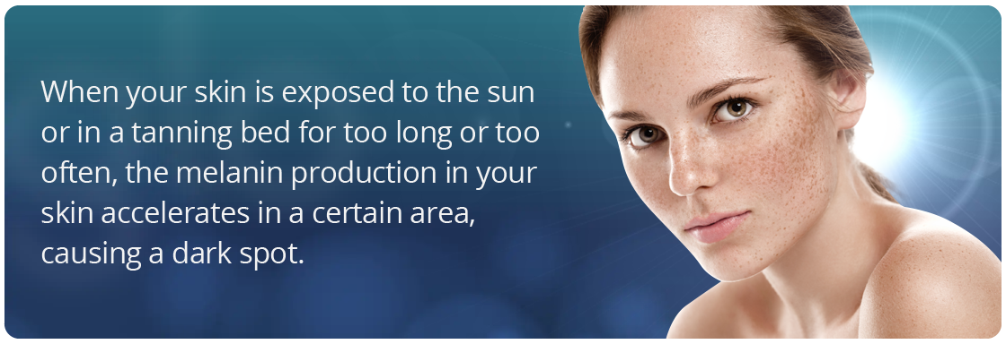 How sun and a tanning bed can cause dark spots on your skin