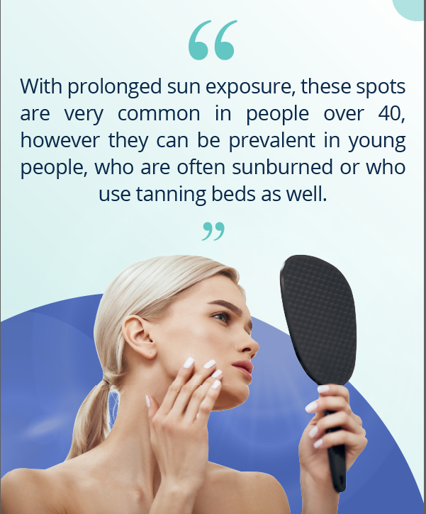 Sun spots: Causes, treatment & prevention