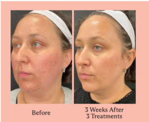 Before and after photos of facelift-like procedure with triLift device.